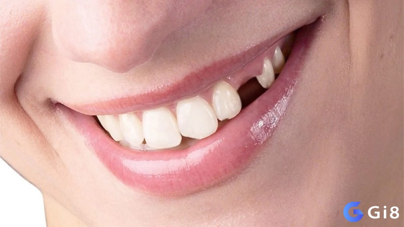Chiêm bao thấy rụng răng là điềm báo tốt cho chuyện tình cảm